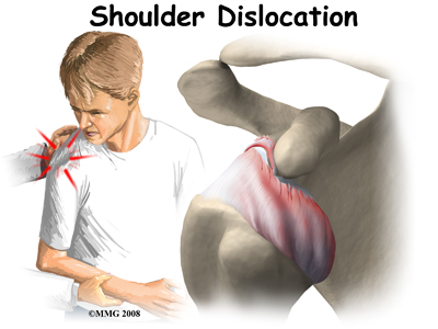 Shoulder Dislocations